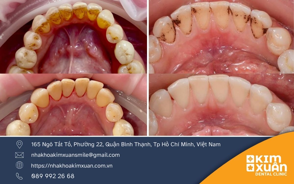 Cạo Vôi Răng Có Đau Không?