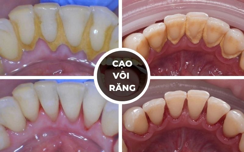 Cạo Vôi Răng