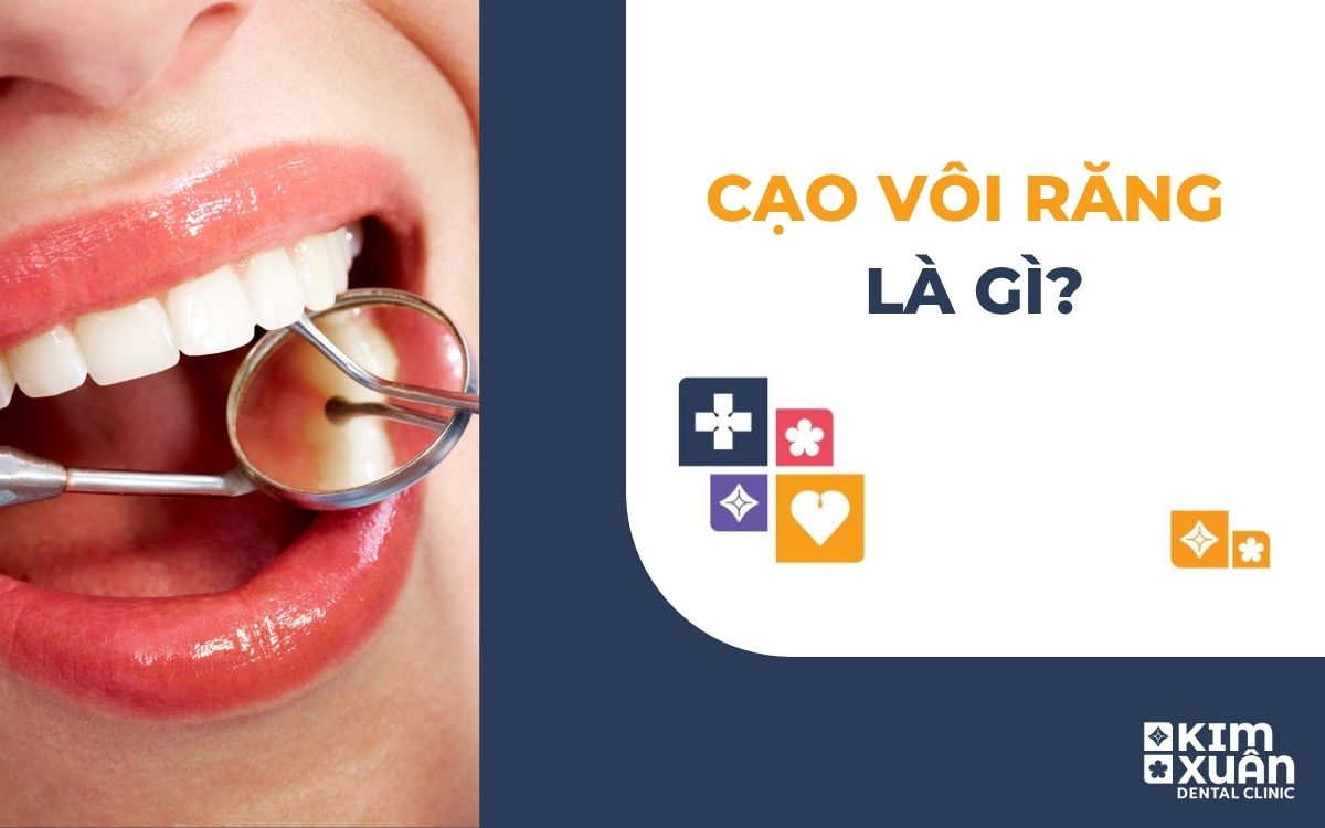 Cạo Vôi Răng Là Gì?