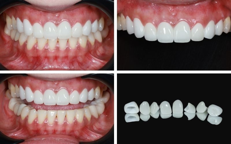 Hình ảnh trước và sau phục hình mão sứ thẩm mỹ vùng răng cửa