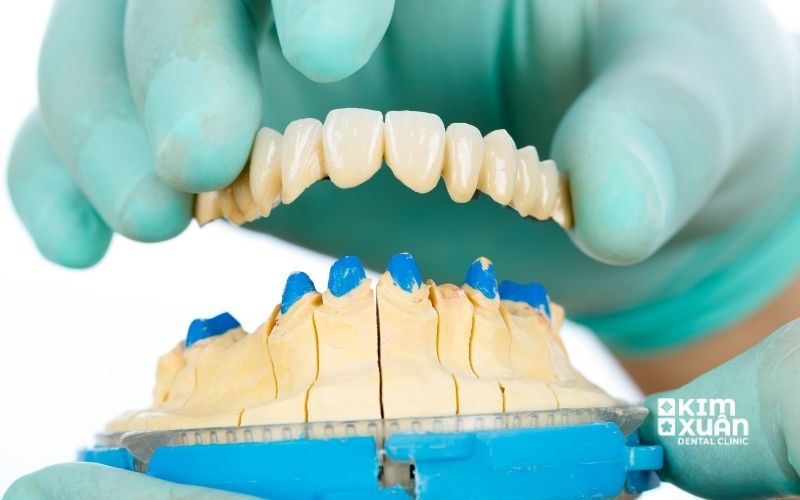 Cấu Tạo Cầu Răng Sứ