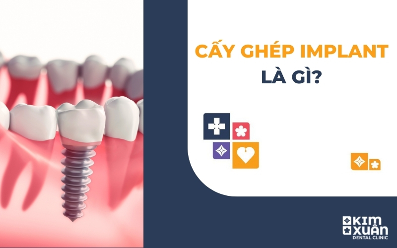 Trồng Răng Implant Nha Khoa Kim Xuân