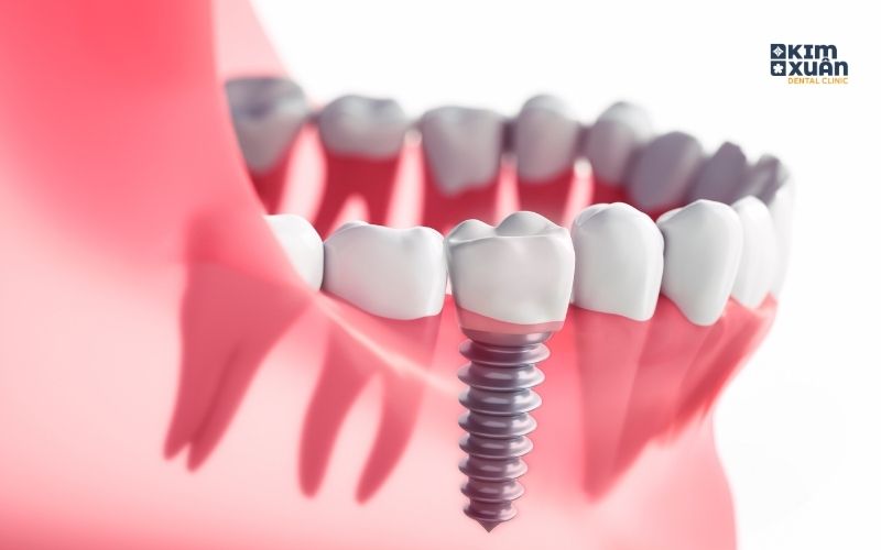 Cấy Ghép Implant