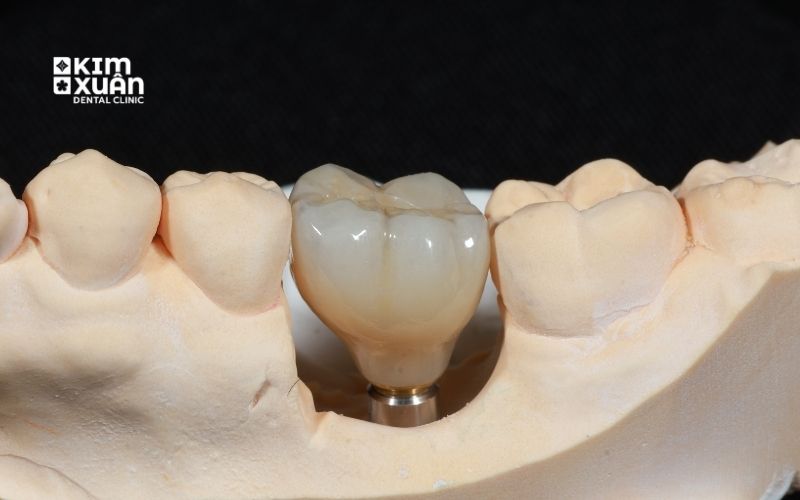 Cấy Ghép Implant Có Đau Không