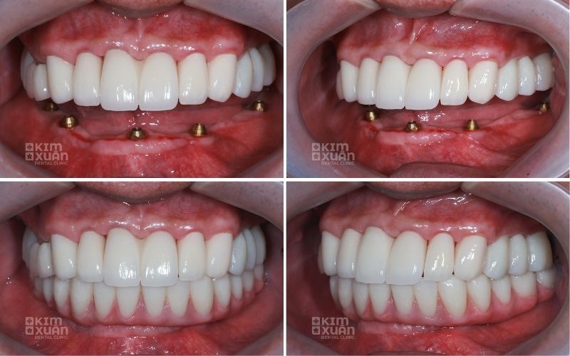 Cấy Ghép Implant Giá Bao Nhiêu