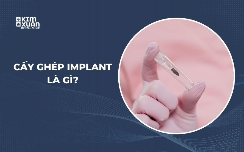 Cấy Ghép Implant