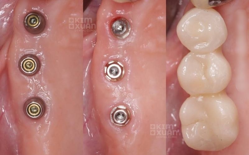 Cấy Ghép Implant Mất Bao Lâu Tại Nha Khoa Kim Xuân