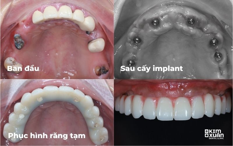 Hình ảnh trước và sau cấy implant toàn hàm và phục hình răng sứ