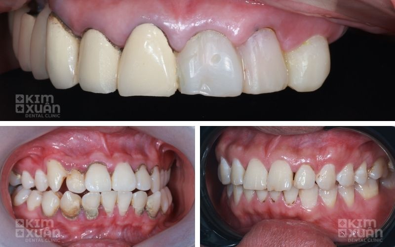 Chân Răng Bị Đen Do Bọc Sứ Kim Loại