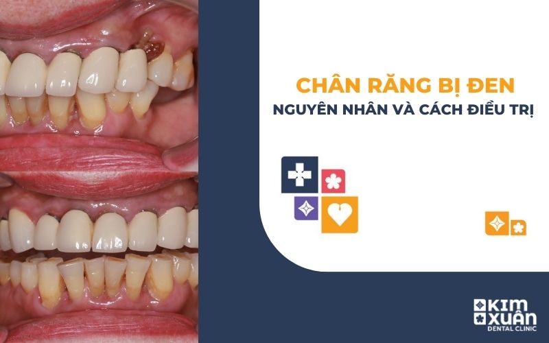 Chân Răng Bị Đen Nguyên Nhân Và Cách Điều Trị
