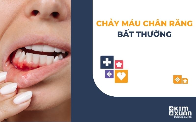 Chảy Máu Chân Răng