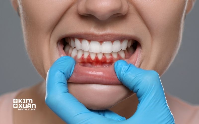 Chảy Máu Chân răng Bất Thường Do Đâu