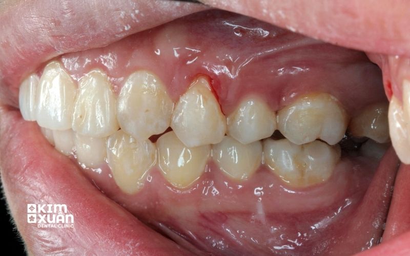 Chảy Maud Chân Răng Do Viêm Lợi Viêm Nha Chu