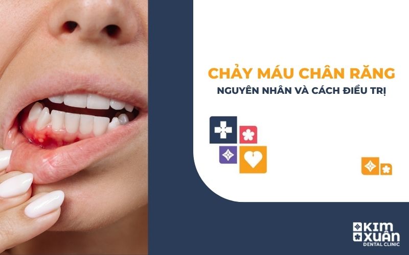 Chảy Máu Chân Răng