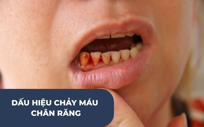 Chảy Máu Chân Răng Là Gì?
