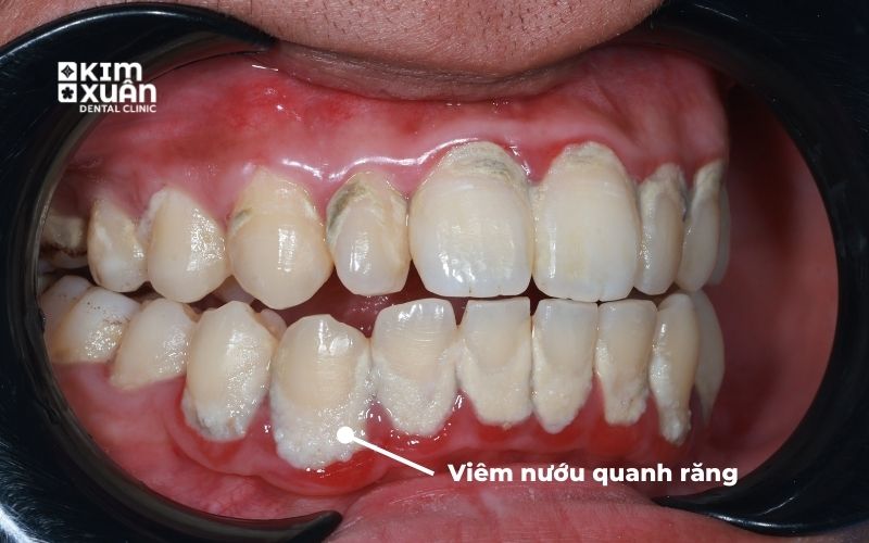 Chảy Máu Răng Do Viêm Nha Chu Và Cao Răng