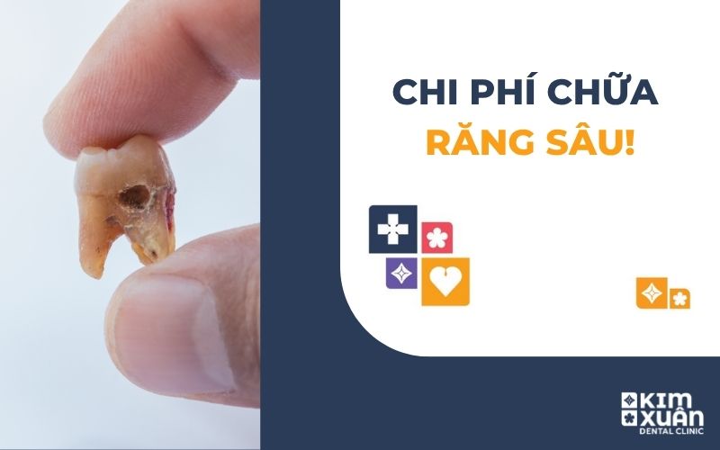 Chi Phí Chữa Răng Sâu Bao Nhiêu