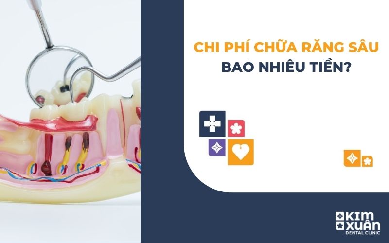 Chi Phí Chữa Răng Sâu Giá Bao Nhiêu