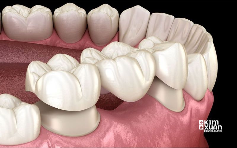 Chi Phí Làm Cầu Răng Sứ Giá Bao Nhiêu