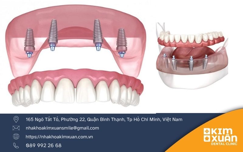 Chi Phí Trồng Răng Implant All On 4 Giá Bao Nhiêu
