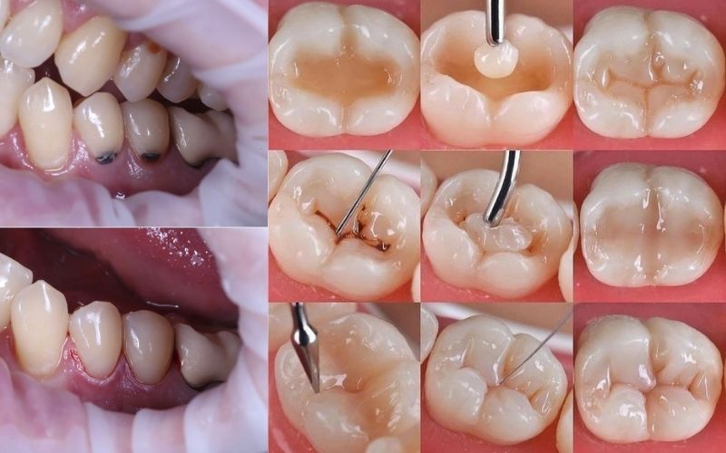Chữa Răng Sâu Giá Bao Nhiêu