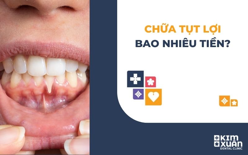 Chữa Tụt Lợi Giá Bao Nhiêu Tiền