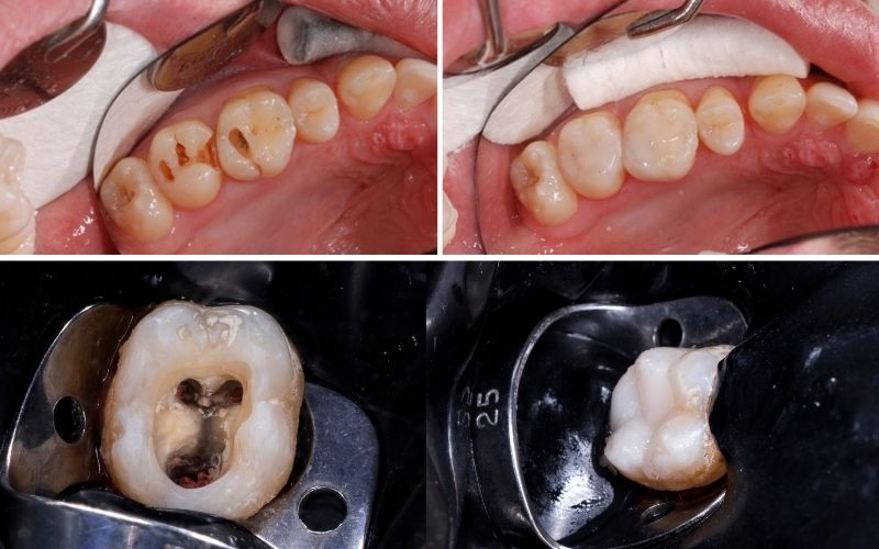 Có Nên Bọc Răng Sứ Sau Khi Lấy Tủy Không
