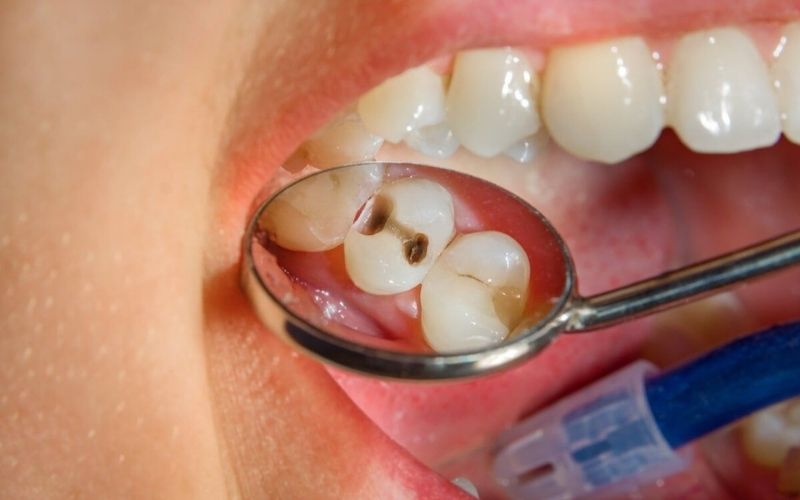 Có Nên Bọc Răng Sứ Sau Khi Lấy Tủy Không