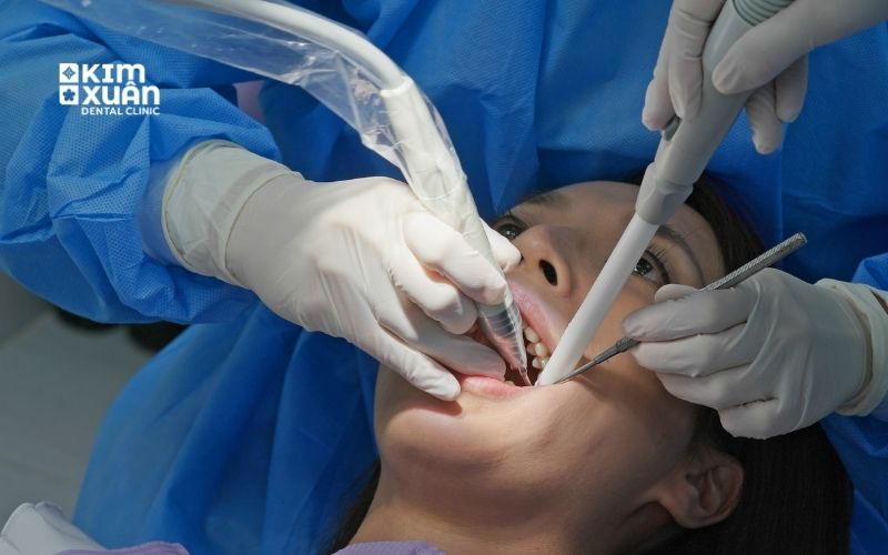 Có Nên Lấy Cao Răng