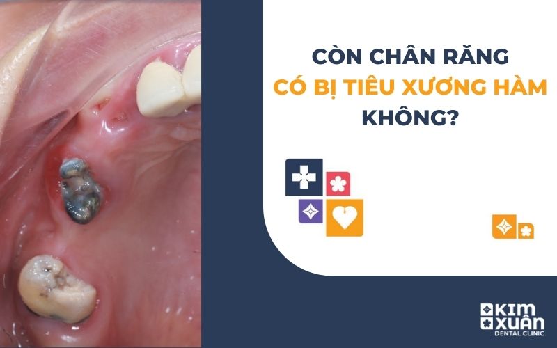 Còn Chân Răng Có Bị Tiêu Xương Hàm Không