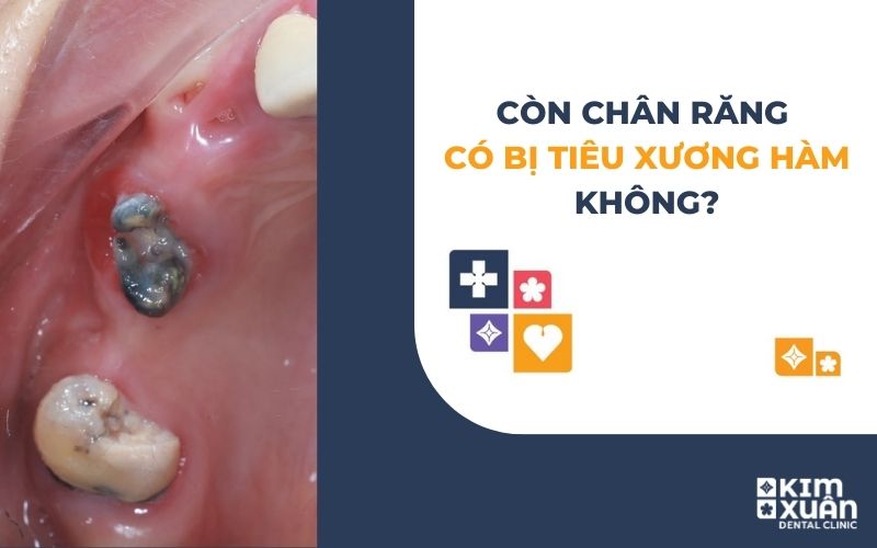 Còn Chân Răng Có Bị Tiêu Xương Hàm Không