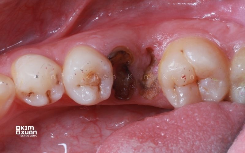 Còn Chân Răng Có Nguy Hiểm Không