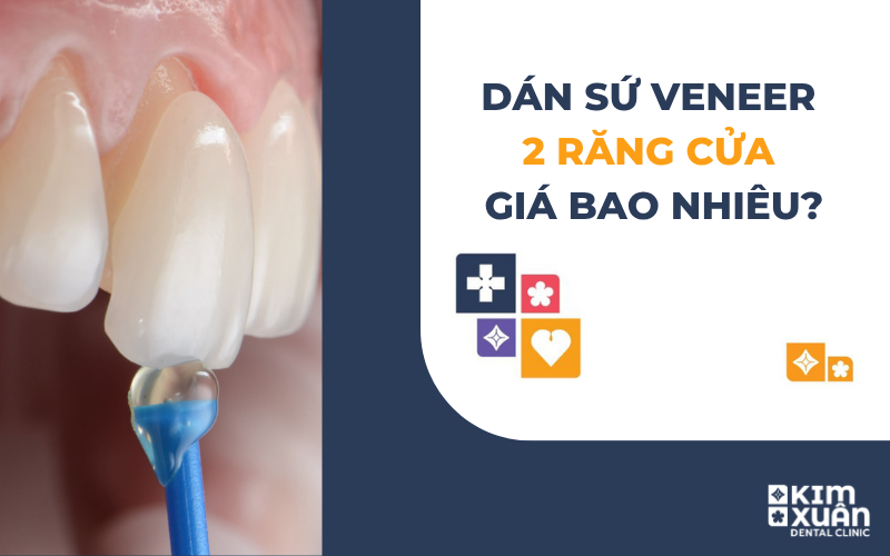 Dán Răng Sứ 2 Răng Cửa Giá Bao Nhiêu Tiền
