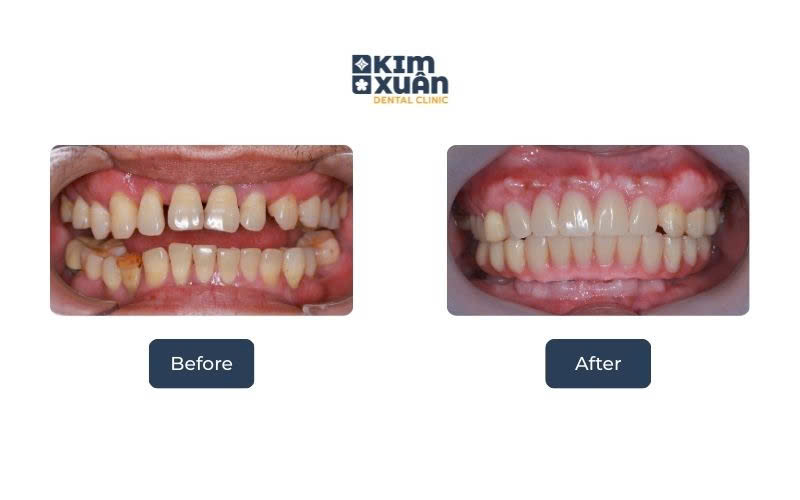 Dán Răng Sứ Veneer Giá Bao Nhiêu