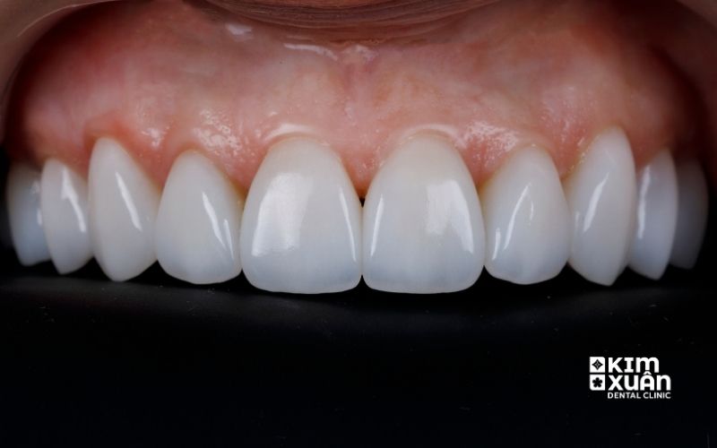 Dán Răng Sứ Nguyên Hàm Giá Bao Nhiêu