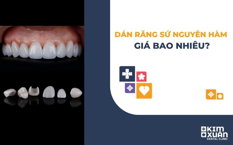 Dán Răng Sứ Nguyên Hàm Giá Bao Nhiêu