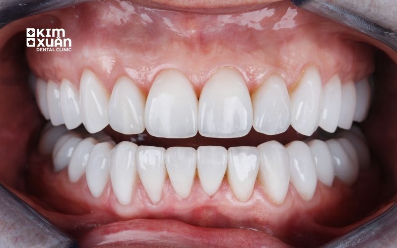 Dán Răng Sứ Nguyên Hàm Giá Bao Nhiêu Tiền