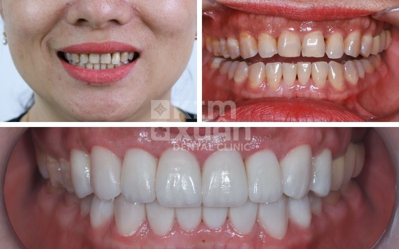 Dán Răng Sứ Nguyên Hàm Tại Nha Khoa Kim Xuân