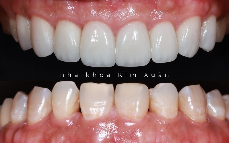 Dán Răng Sứ Tại Nha Khoa Uy Tín Ở TP. HCM