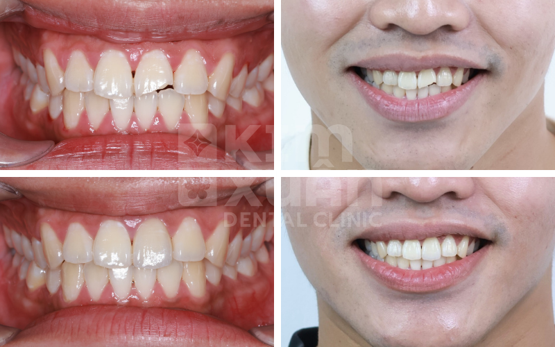 Dán Răng Sứ Veneer 2 Răng Cửa Tại Nha Khoa Kim Xuân