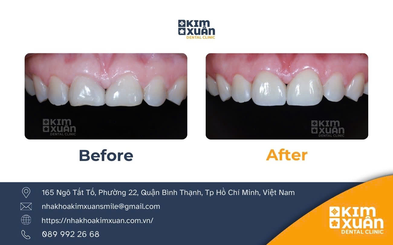 Dán Răng Sứ Veneer
