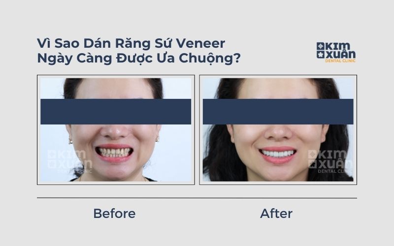 Dán Răng Sứ Veneer