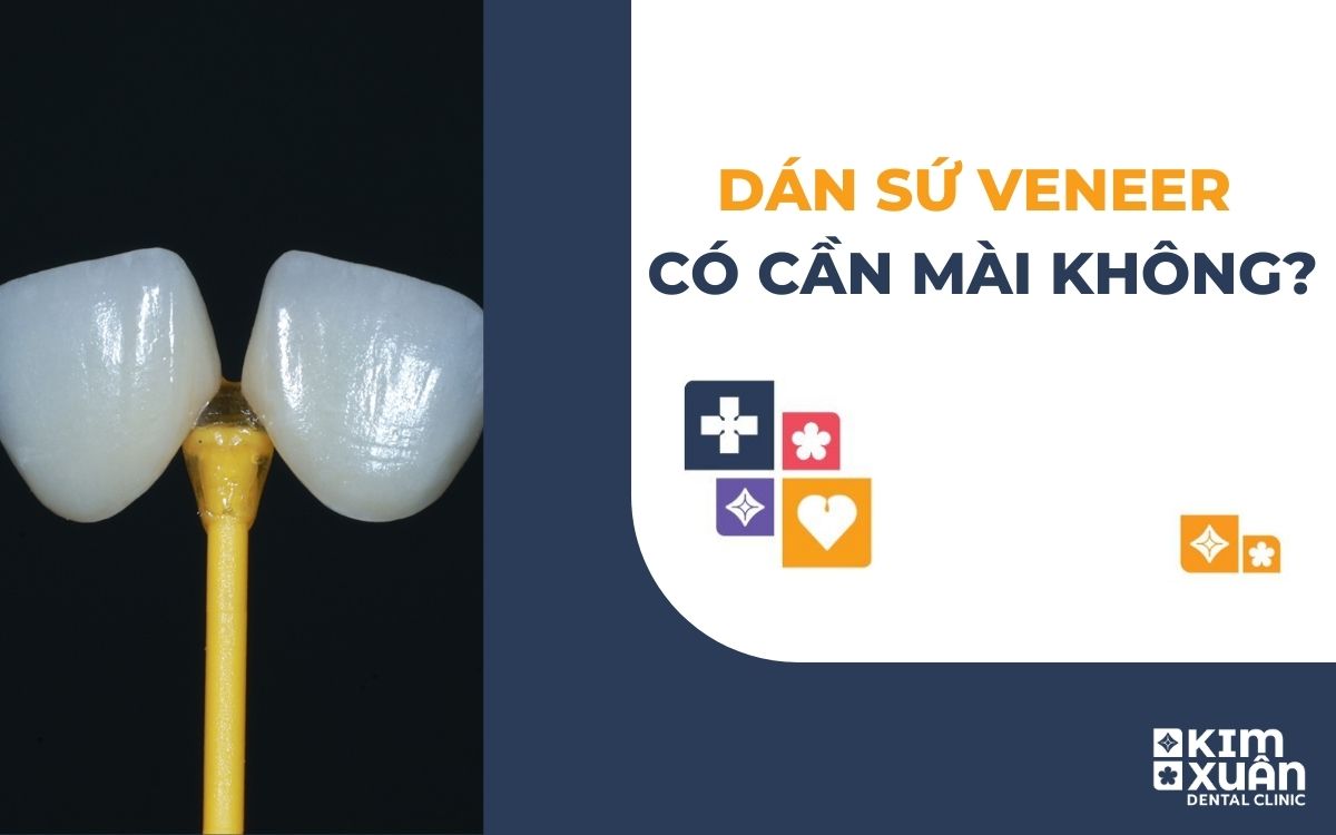 Dán Răng Sứ Veneer Có Cần Mài Răng Không