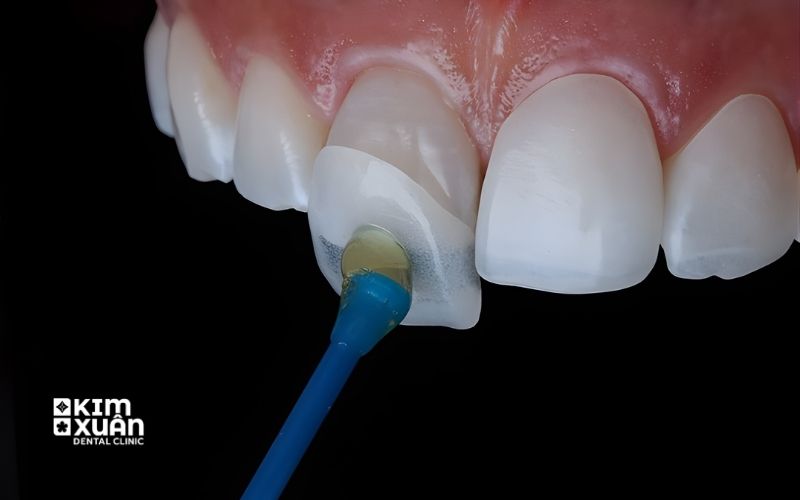 Dán Răng Sứ Veneer Giá Bao Nhiêu