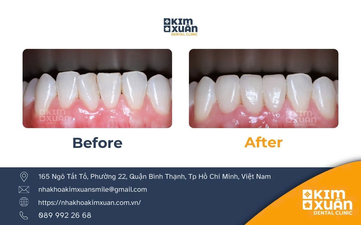 Dán Răng Sứ Veneer Giá Bao Nhiêu