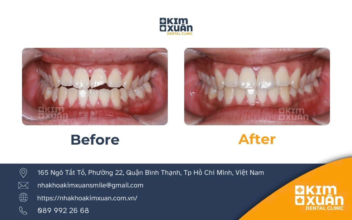 Dán Răng Sứ Veneer