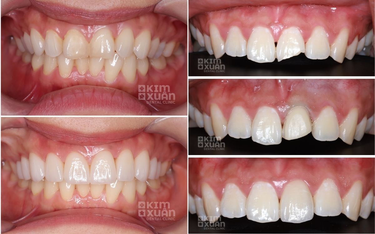 Dán Răng Sứ Veneer Có Cần Mài Răng Không