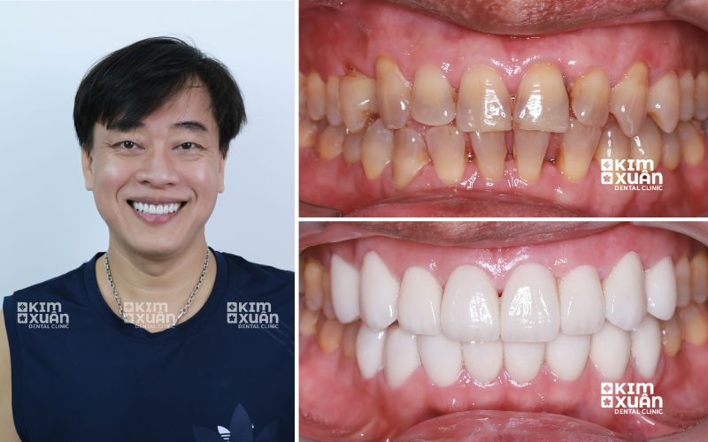 Trước Và Sau Khi Dán Sứ Veneer