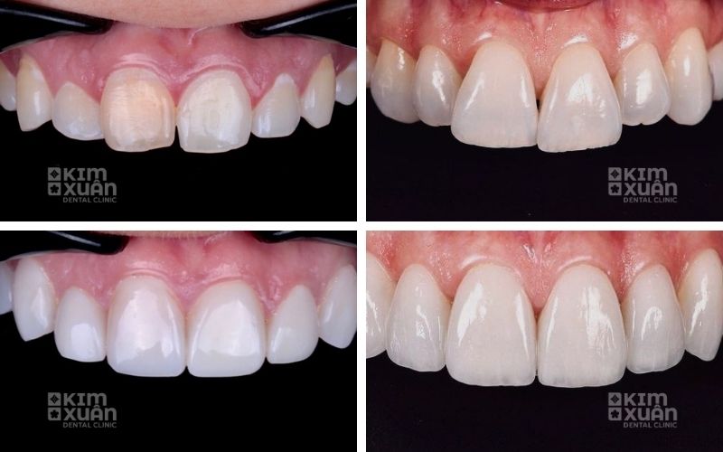 Dán Răng Sứ Veneer Tại Nha Khoa Kim Xuân