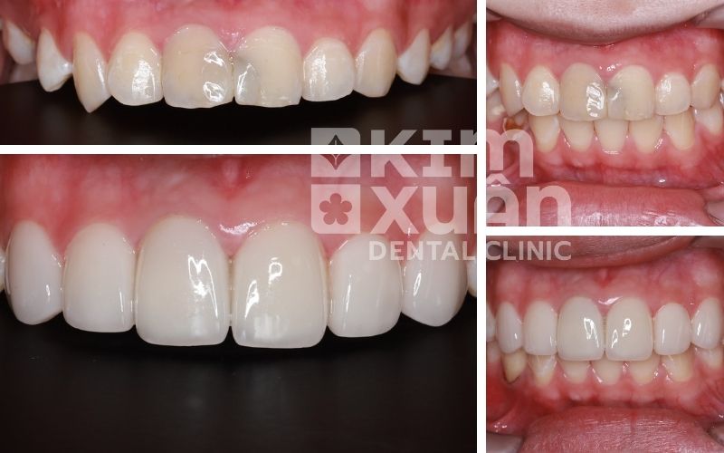 Dán Răng Sứ Veneer Tại Nha Khoa Kim Xuân